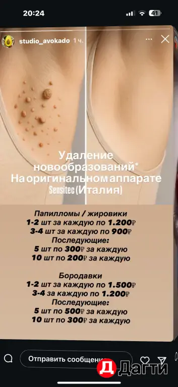 Удаление новообразований*На оригинальном аппаратеSensitec (Италия)