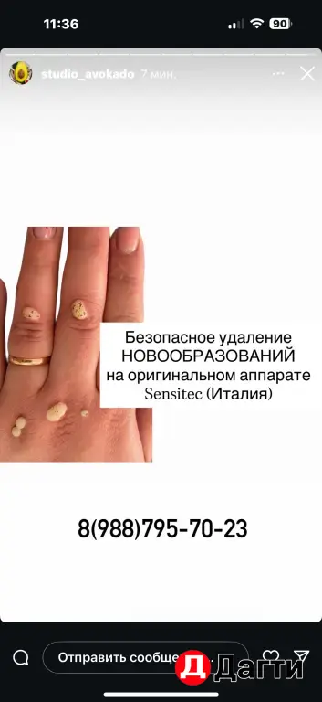 Удаление новообразований*На оригинальном аппаратеSensitec (Италия)