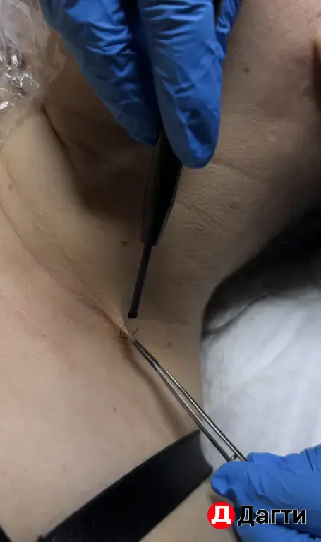 Удаление новообразований*На оригинальном аппаратеSensitec (Италия)