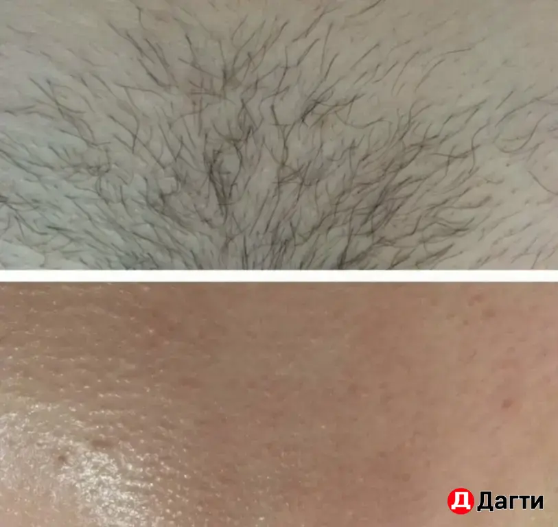 Лазерная эпиляция