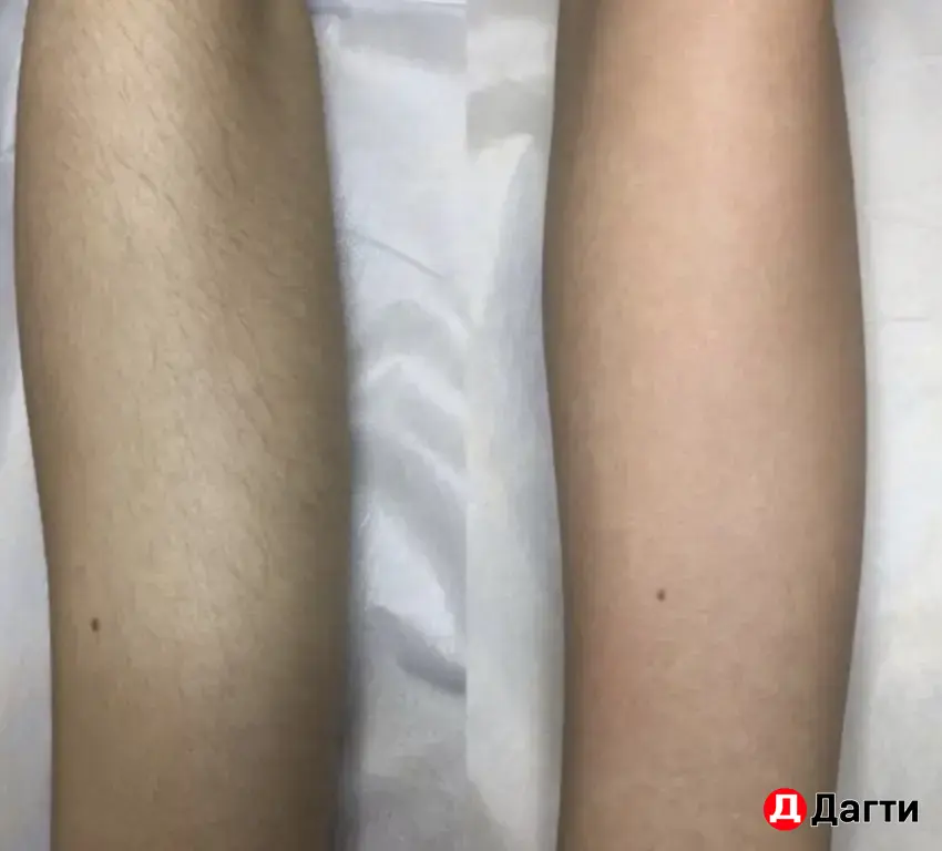 Лазерная эпиляция