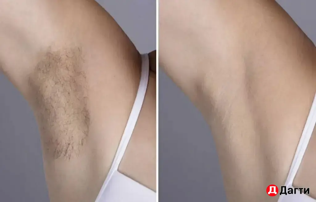 Лазерная эпиляция