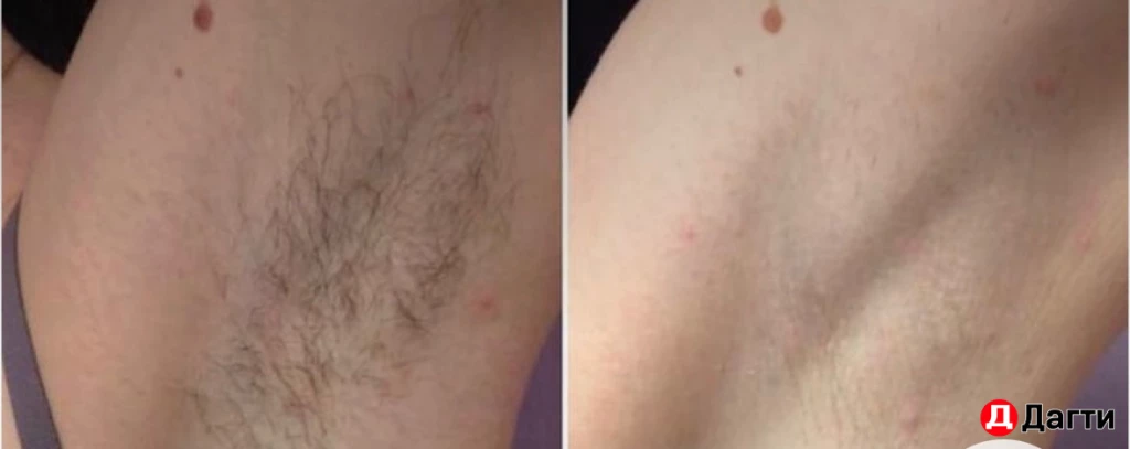 Депиляция воском