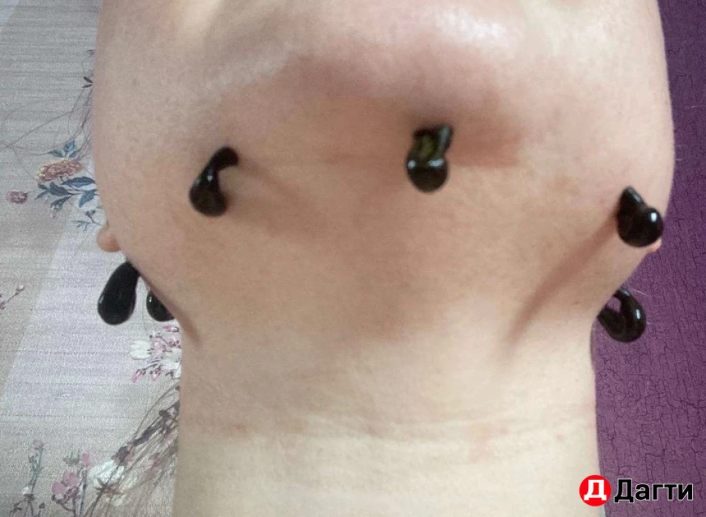 Пиявка медицинская.