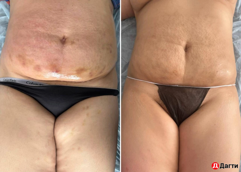 Максисфера (аналог эндосферы)