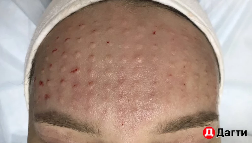 Биоревитализация