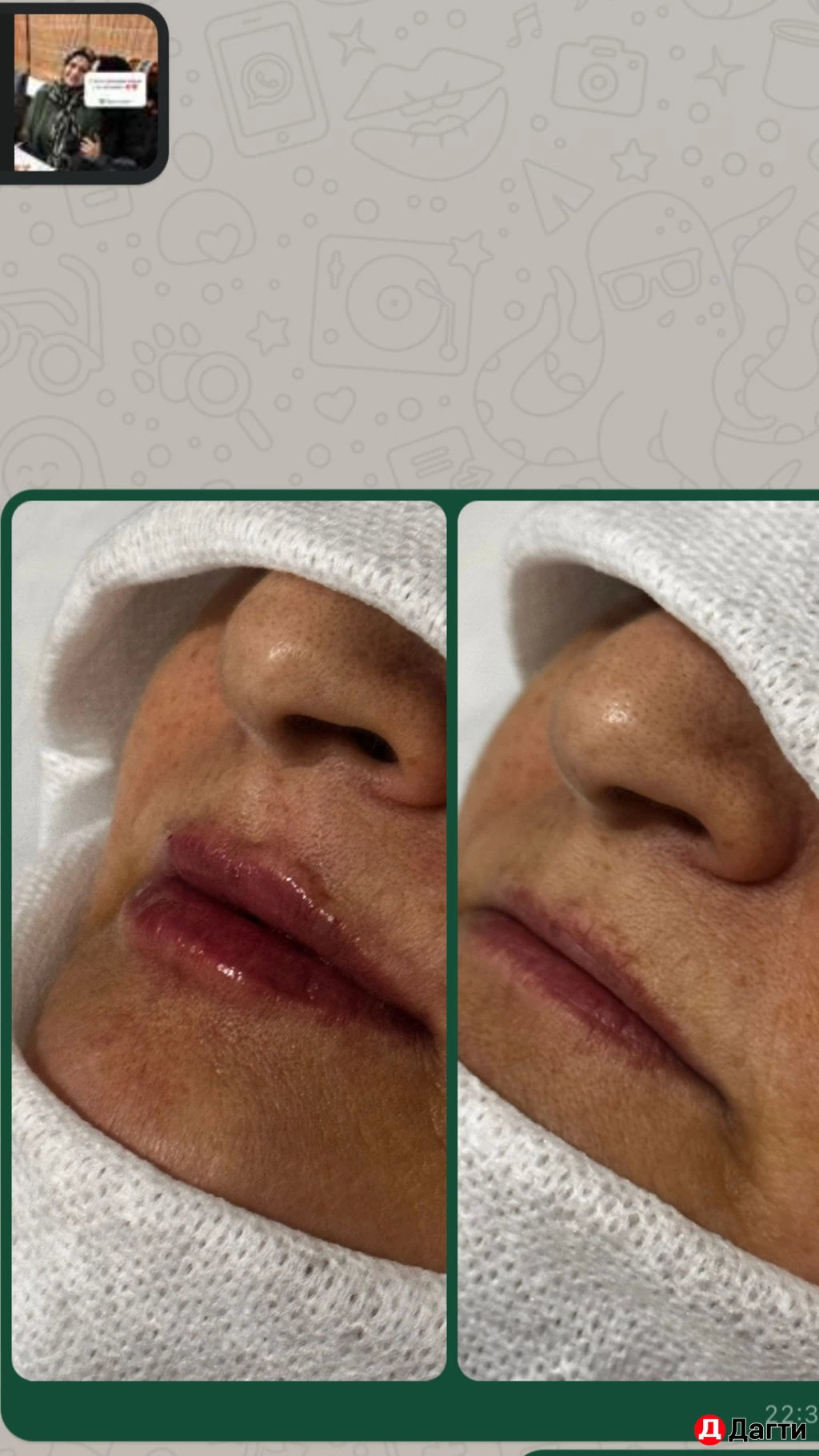 Уколы красоты