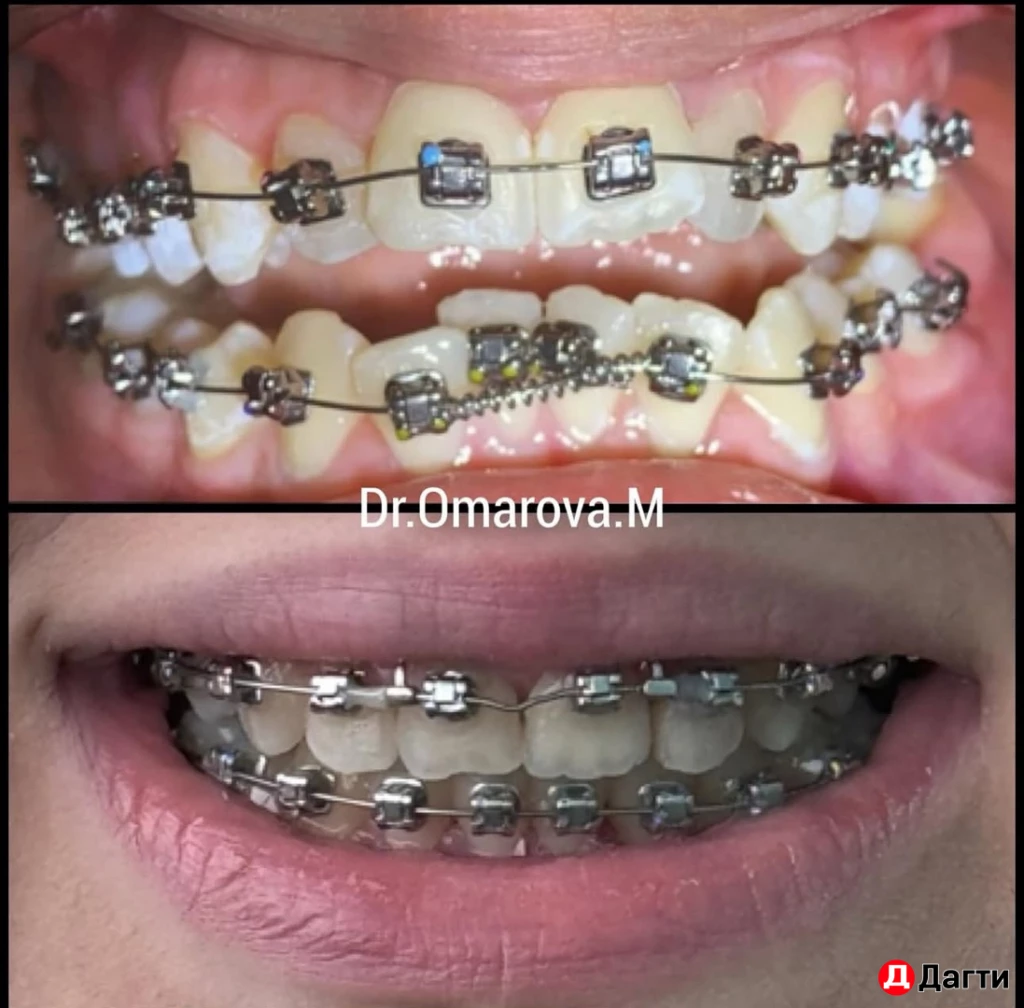 Брекеты