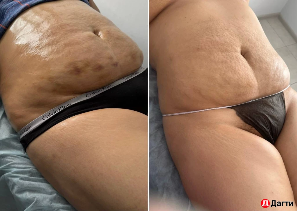 Максисфера (аналог эндосферы)