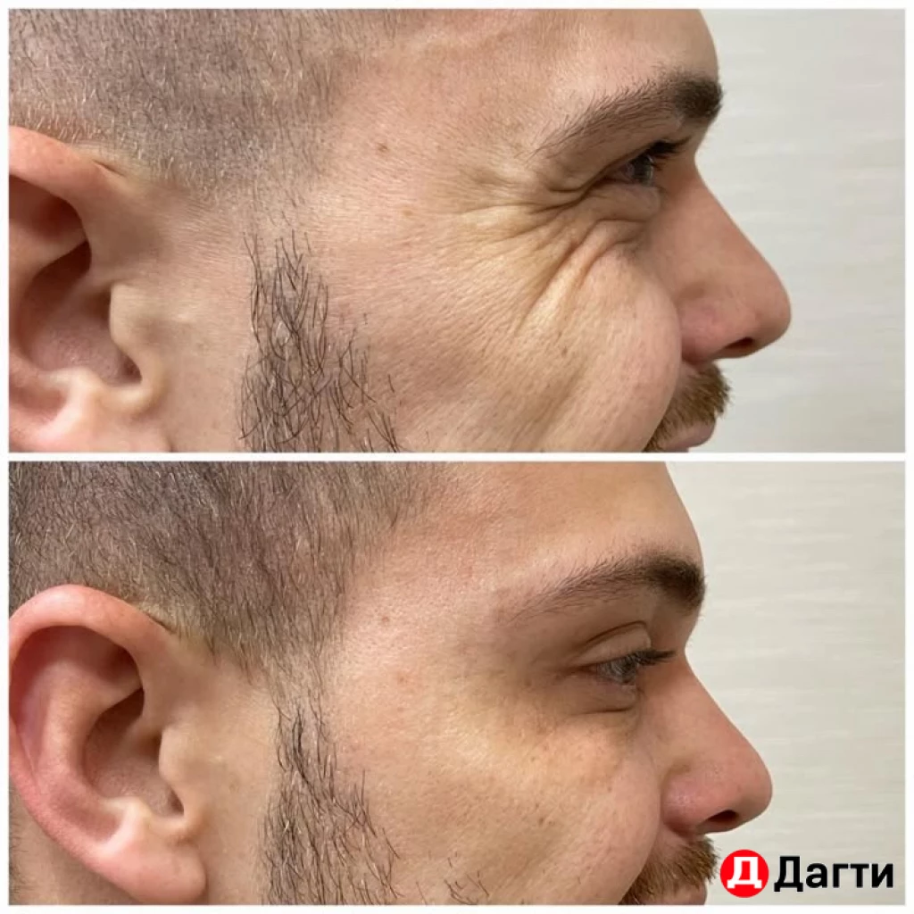 Ботулинотерапия