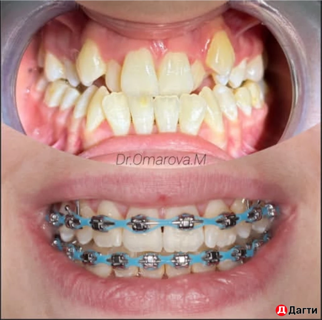 Брекеты