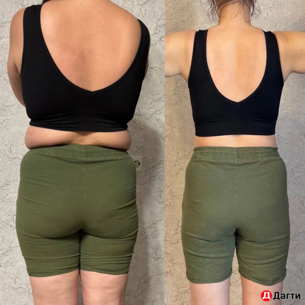 Аппаратный массаж / LPG / Снижение веса