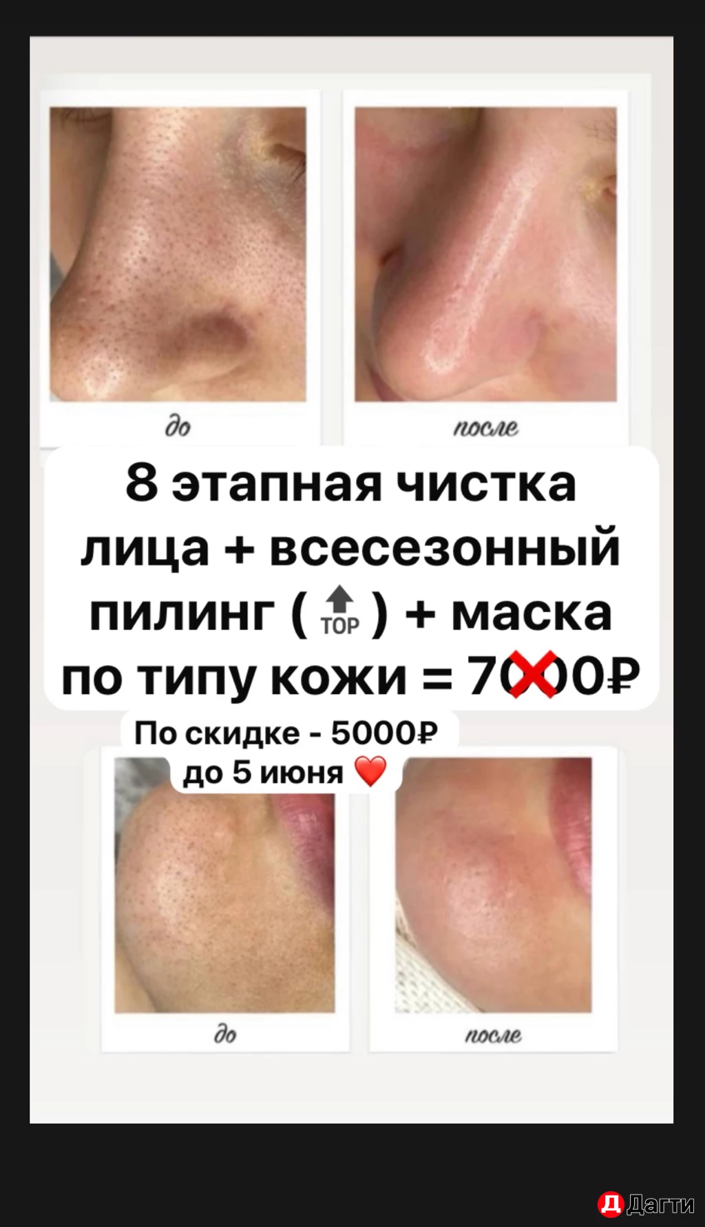 Биоревитализация