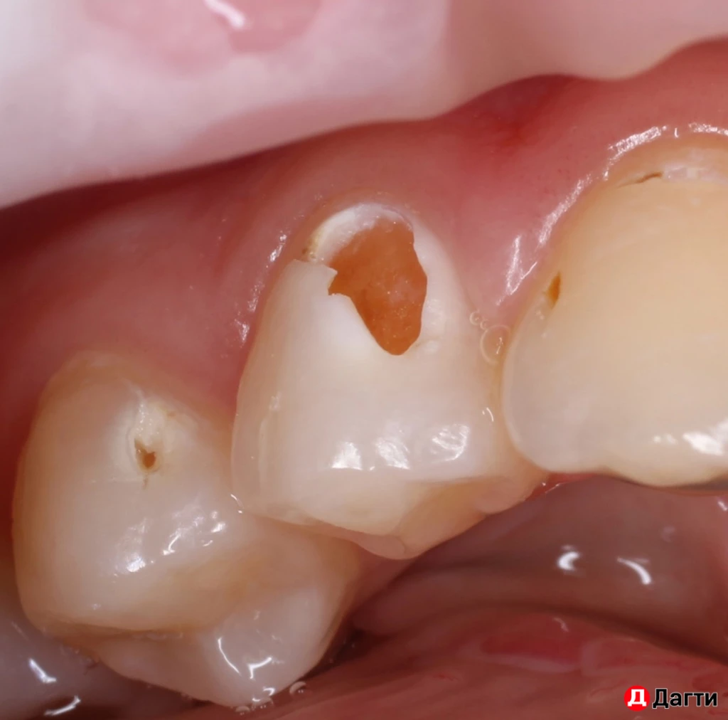 Лечение зубов по ОМС