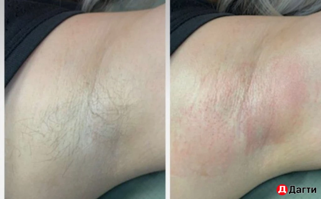 Депиляция воском