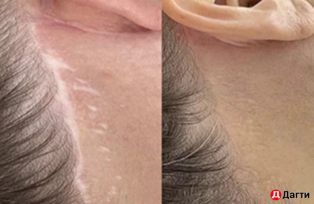 Перманентный камуфляж шрамов/рубцов, растяжек, витилиго