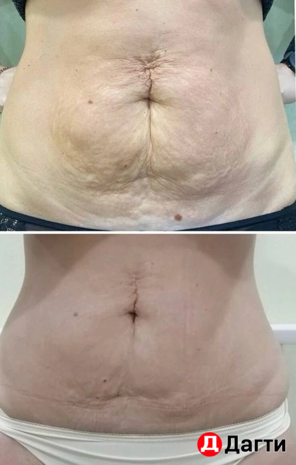 Максисфера (аналог эндосферы)