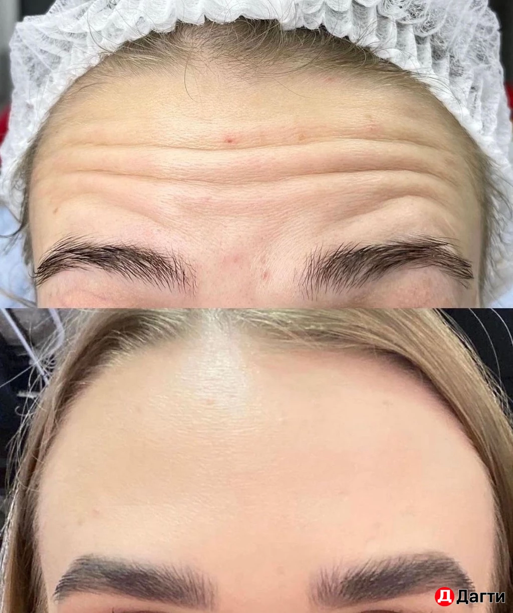 Ботулинотерапия