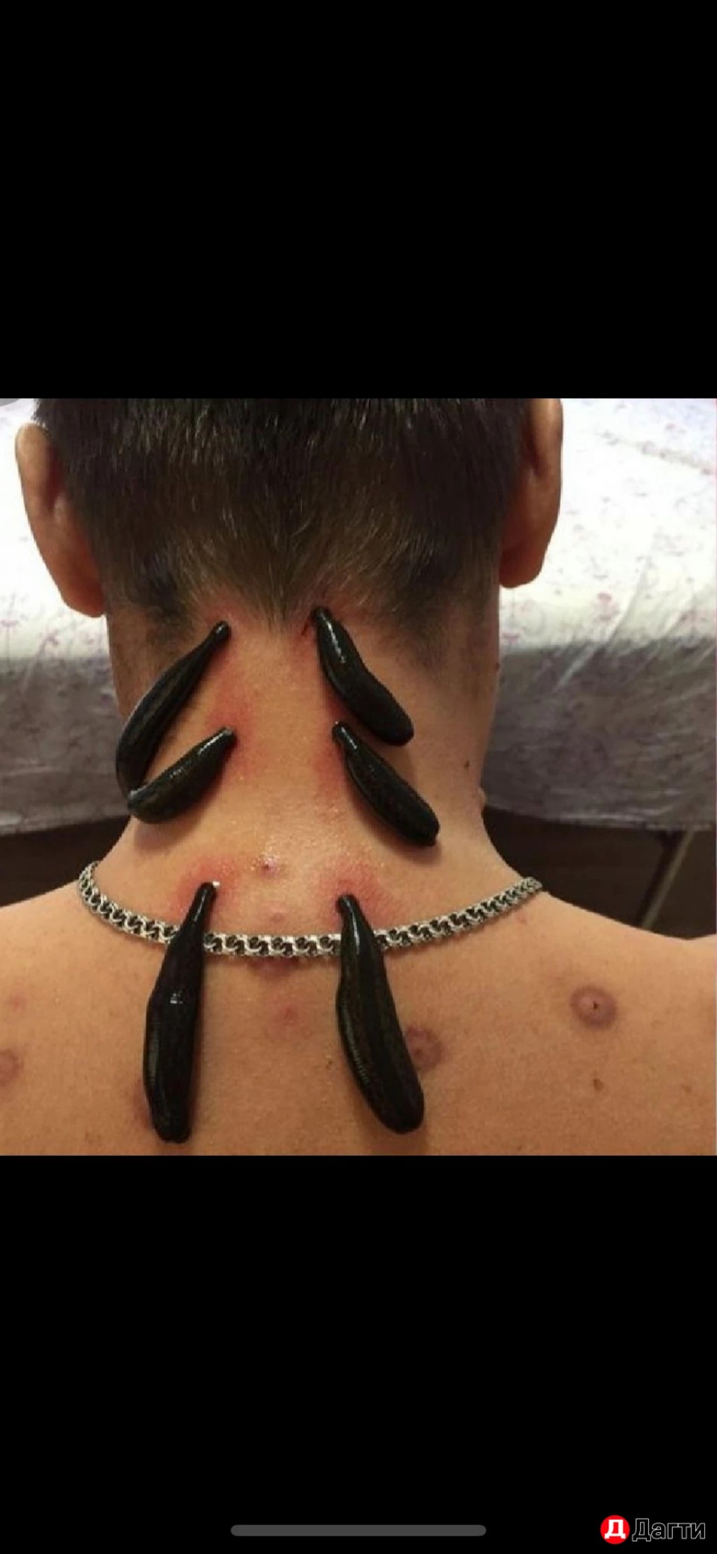 Пиявка медицинская.