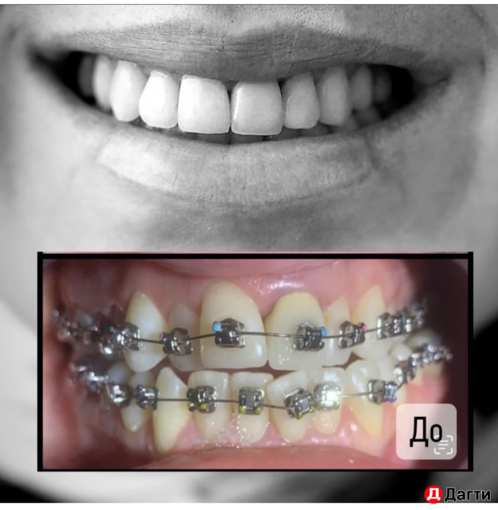 Брекеты