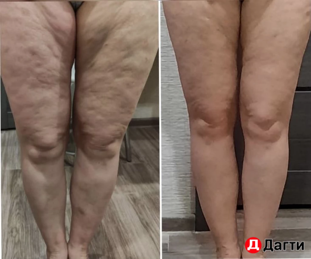 Максисфера (аналог эндосферы)