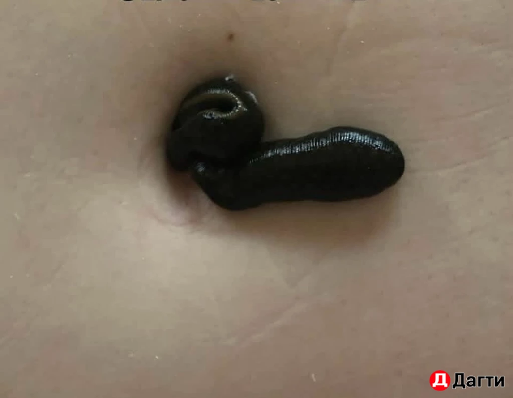 Пиявка медицинская.