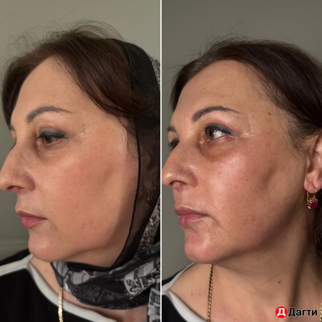 Нужна модель на французский жидкий лазер