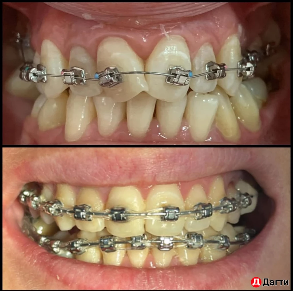 Брекеты