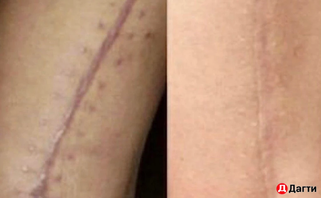 Перманентный камуфляж шрамов/рубцов, растяжек