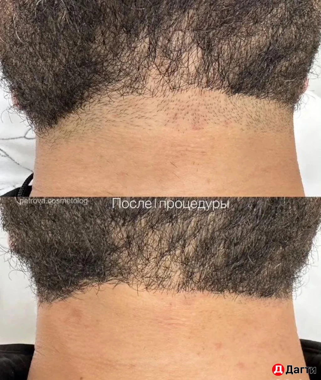 Мужская Лазерная эпиляция