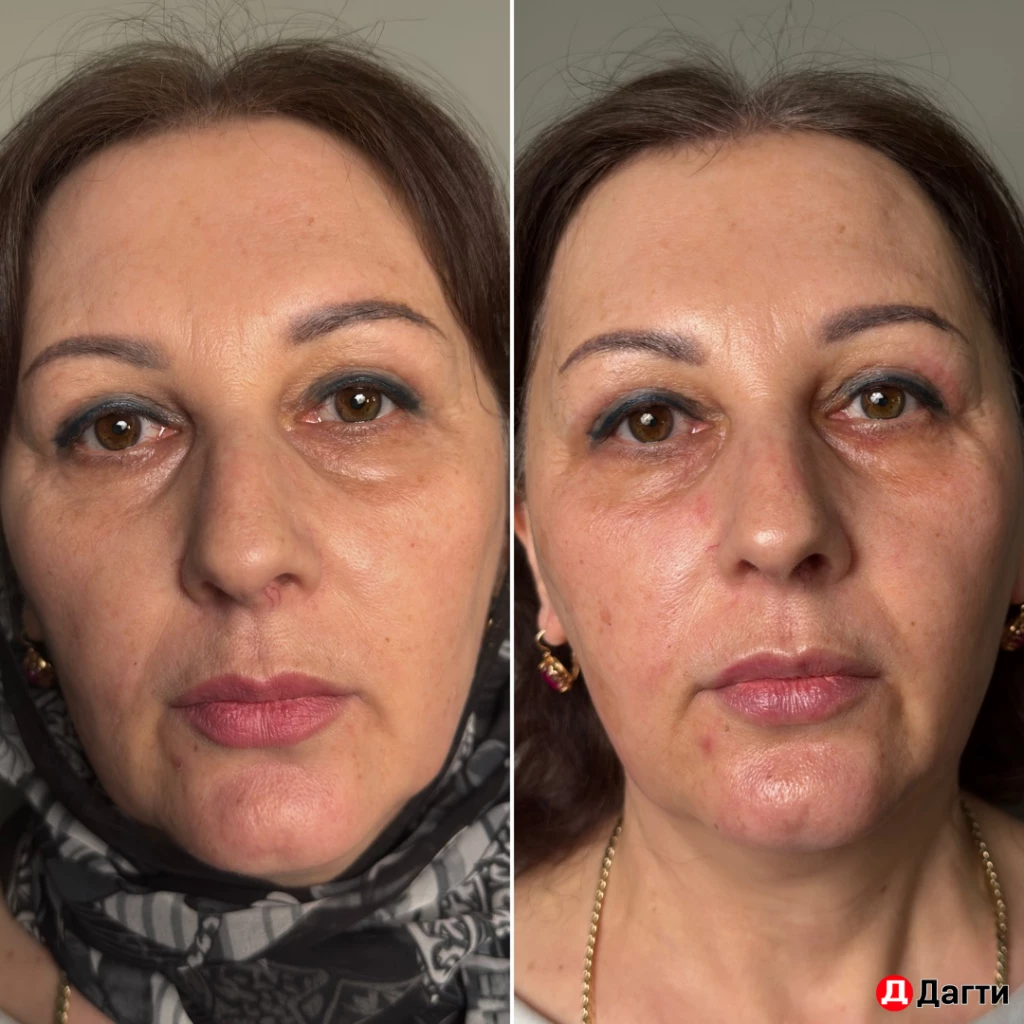 Нужна модель на французский жидкий лазер