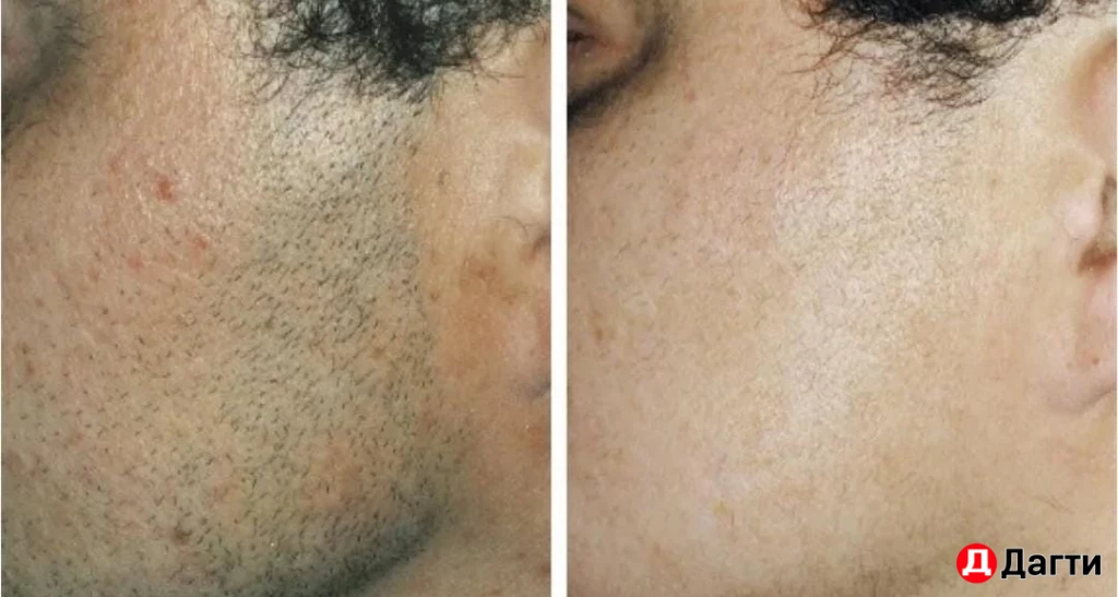 Мужская Лазерная эпиляция