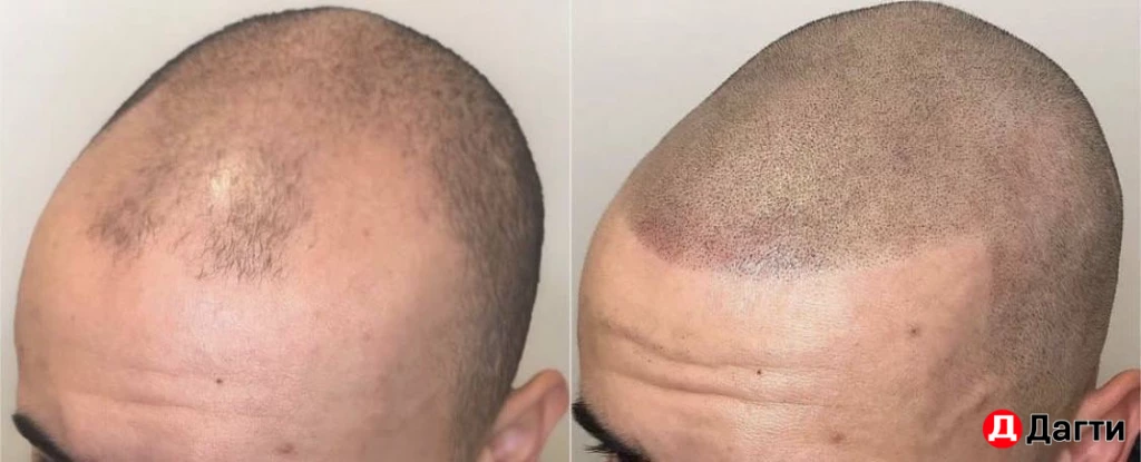 Перманентный камуфляж алопеции