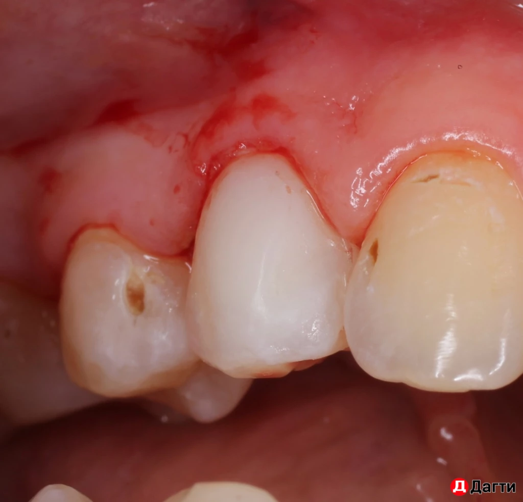 Лечение зубов по ОМС