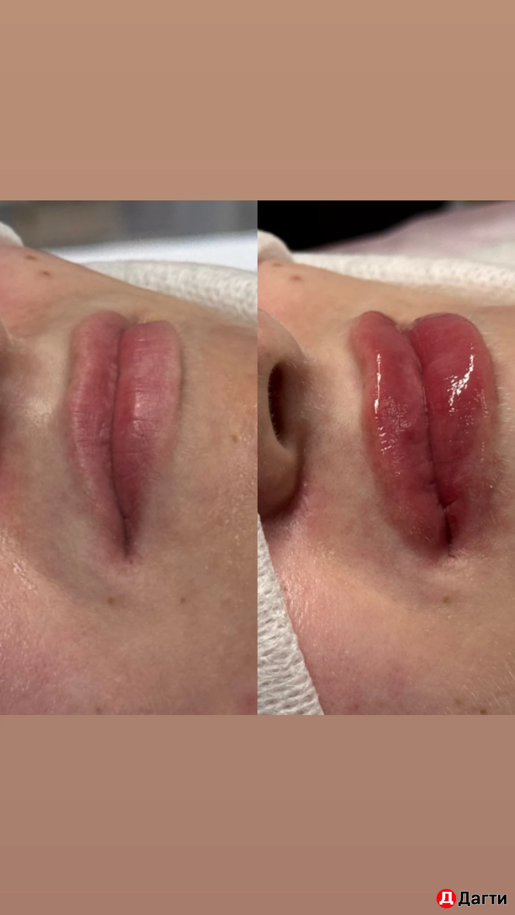 Уколы красоты