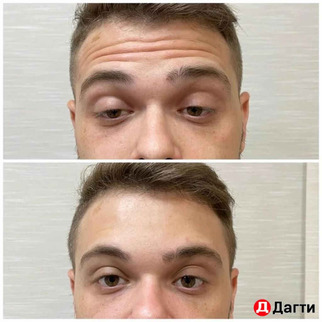 Ботулинотерапия