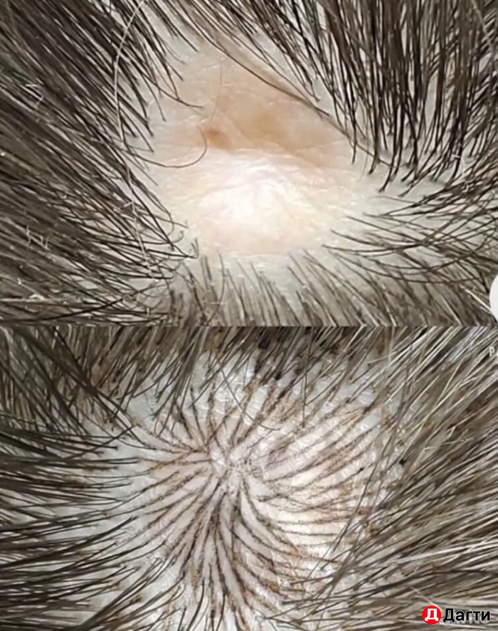 Перманентный камуфляж шрамов/рубцов, растяжек