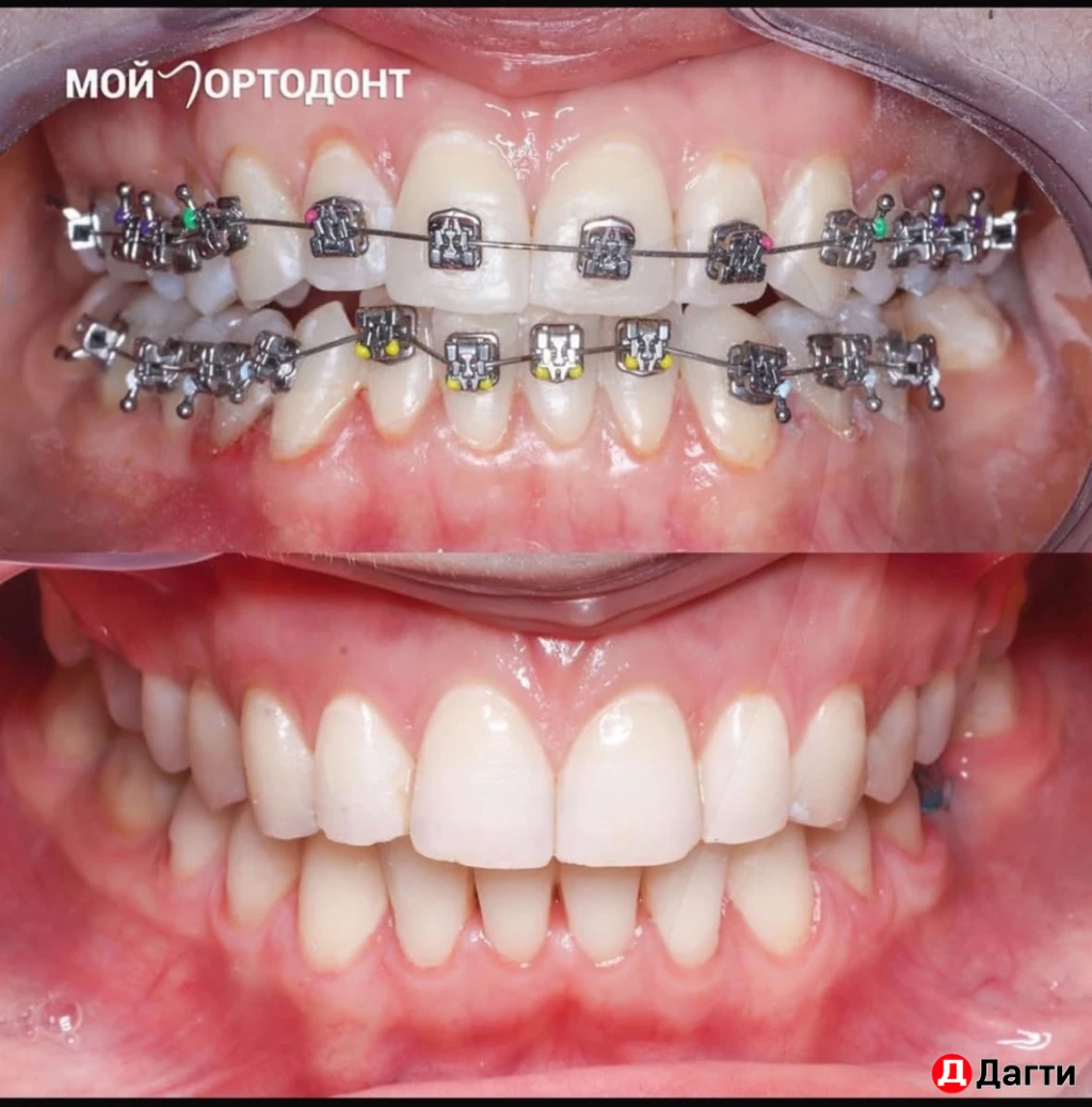 Брекеты