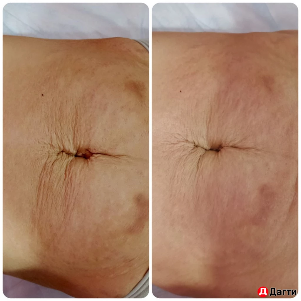 Максисфера (аналог эндосферы)