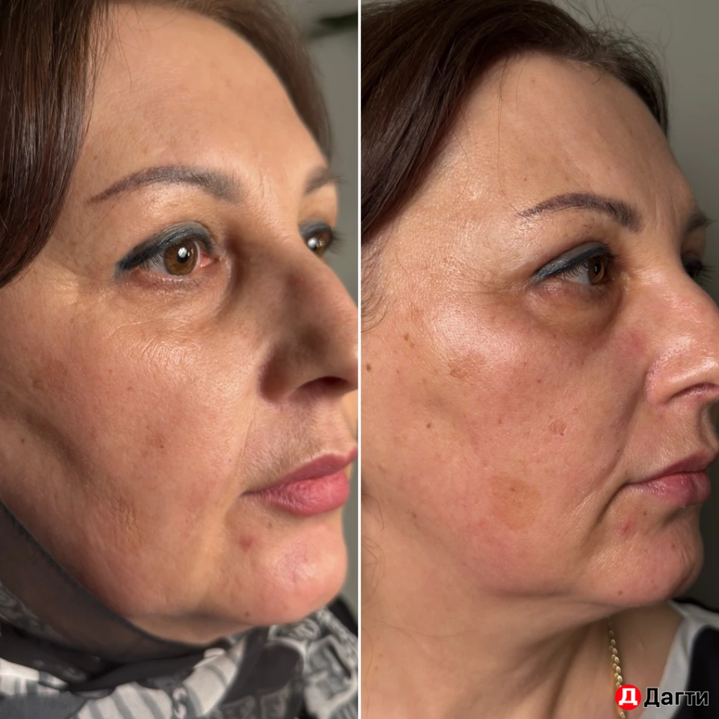 Нужна модель на французский жидкий лазер