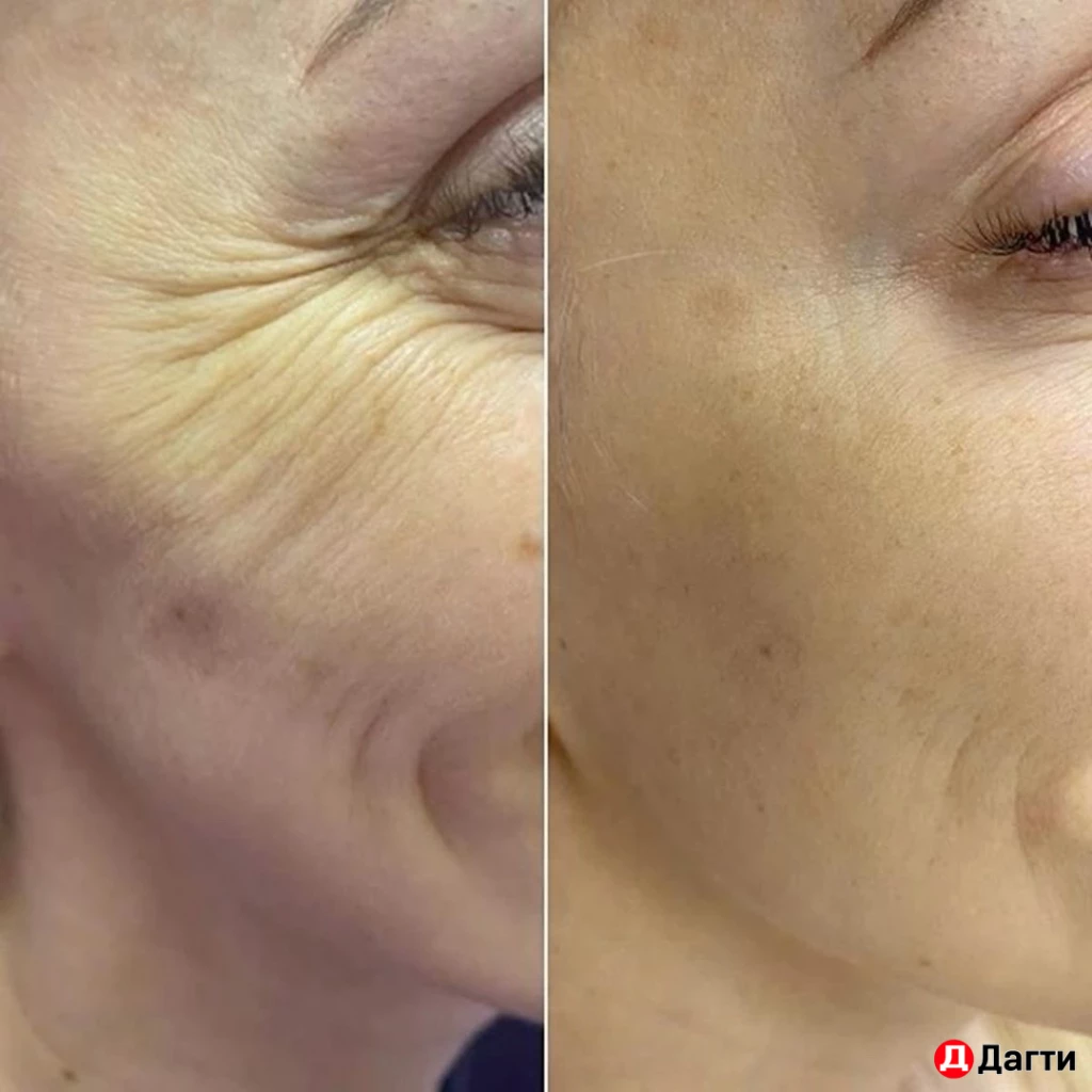 Ботулинотерапия