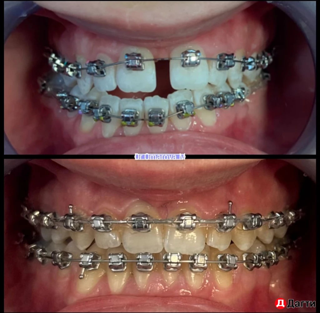 Брекеты