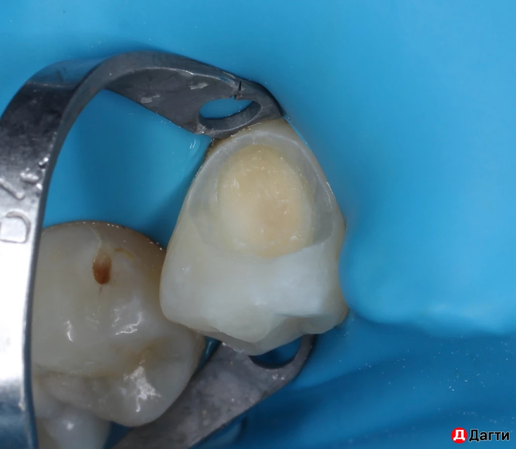 Лечение зубов по ОМС