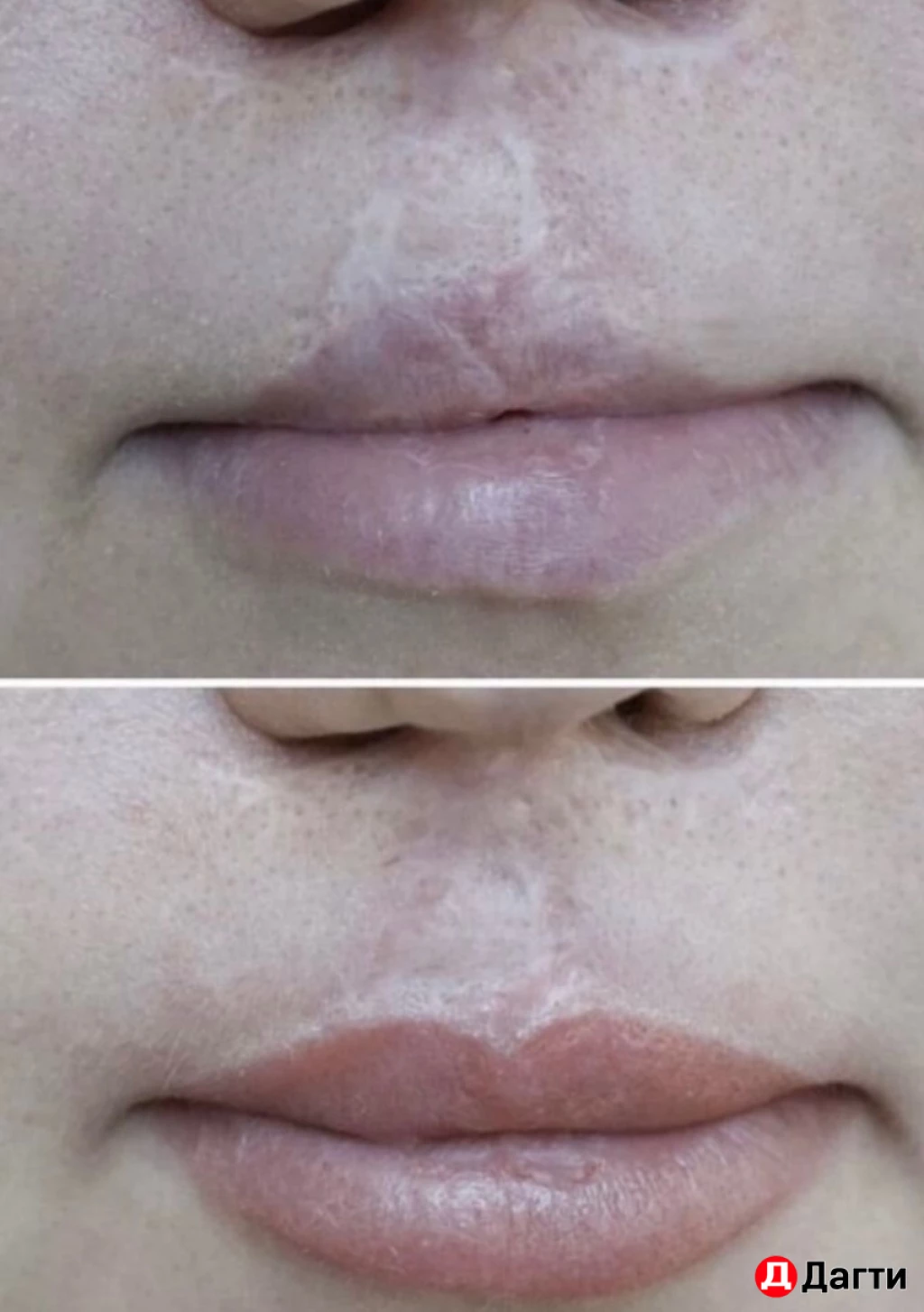 Перманентный камуфляж шрамов/рубцов, растяжек, витилиго