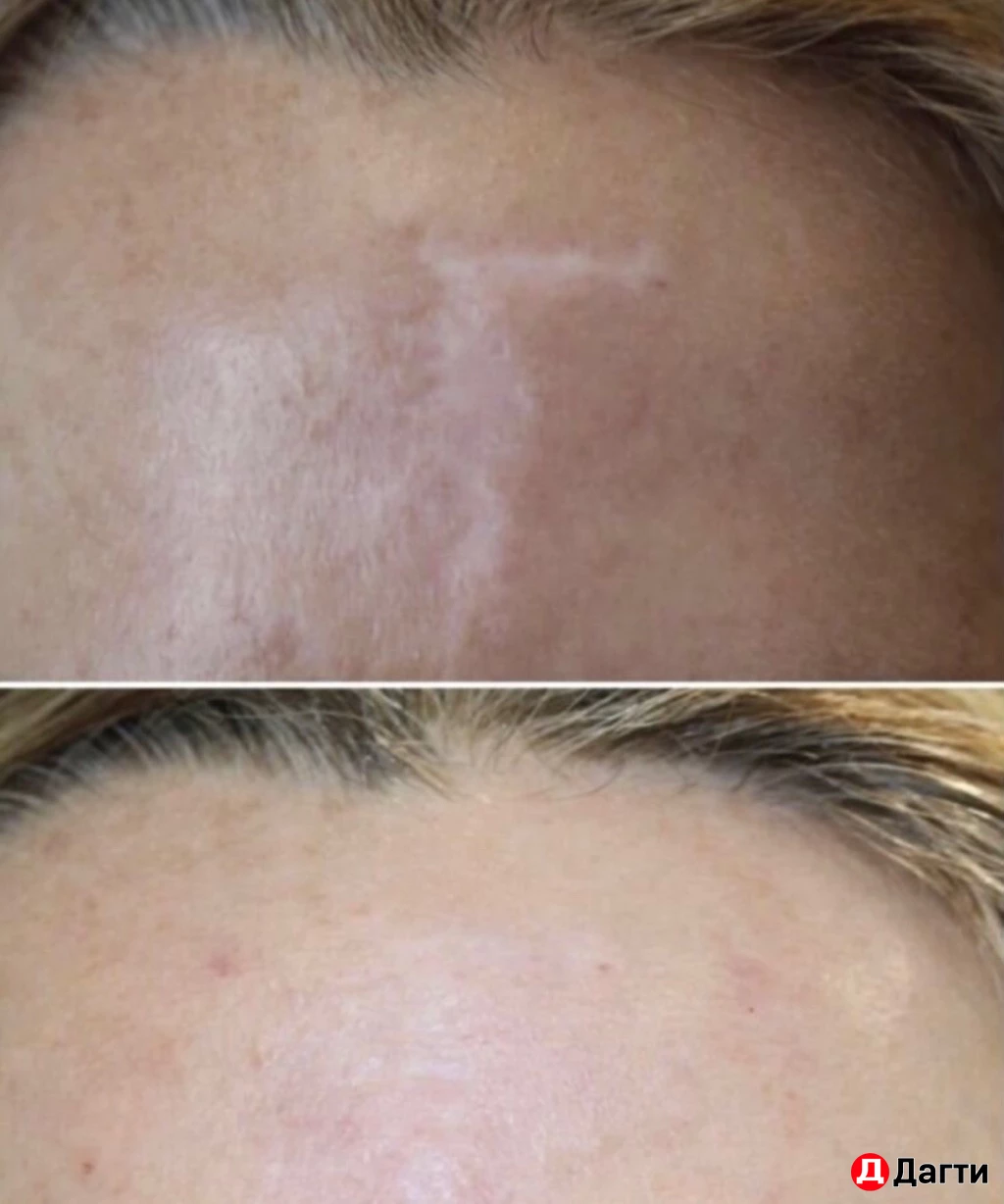 Перманентный камуфляж шрамов/рубцов, растяжек