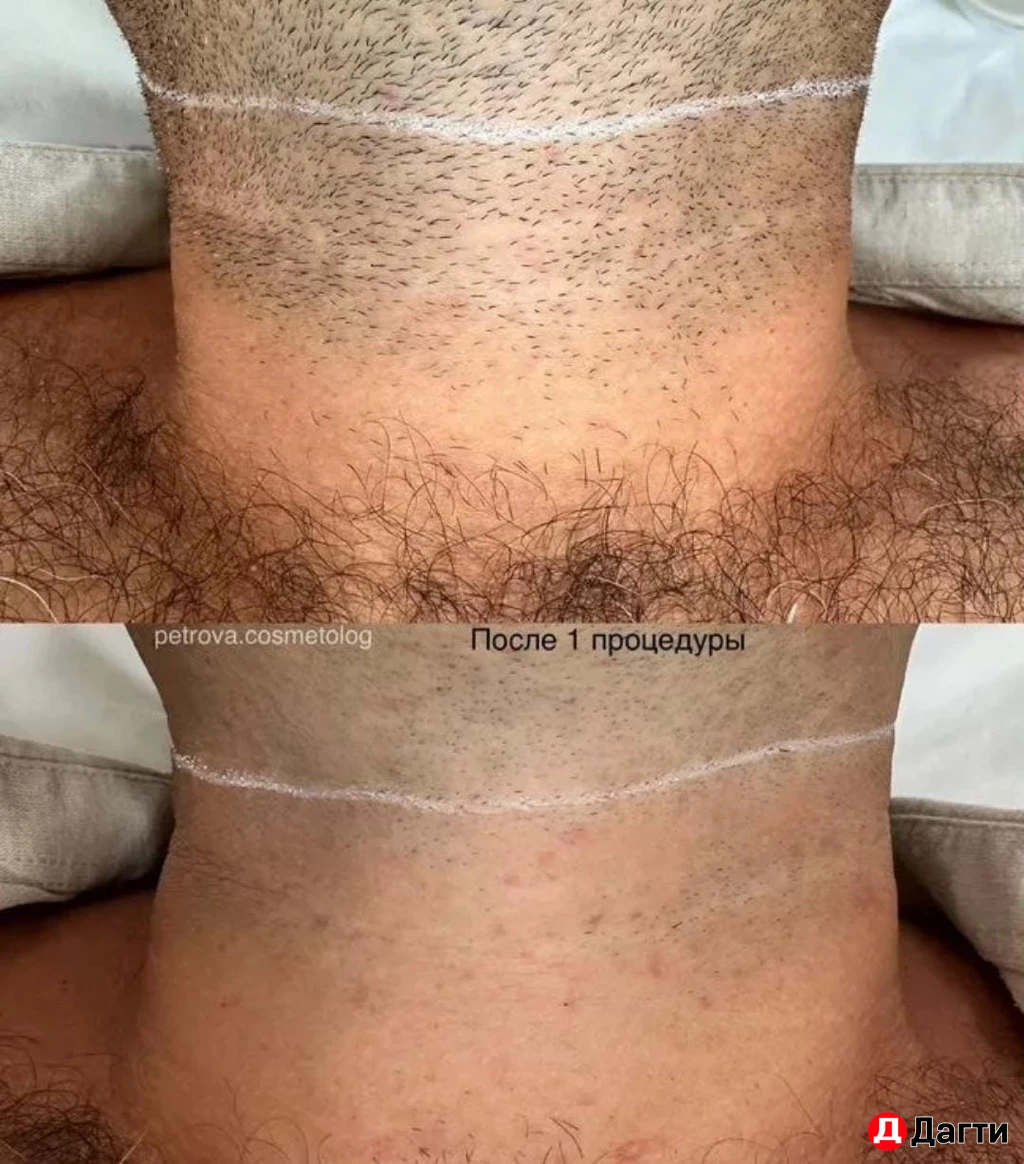 Мужская Лазерная эпиляция