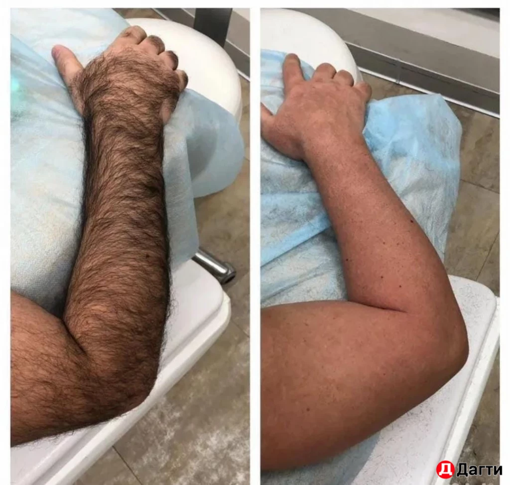 Мужская Лазерная эпиляция