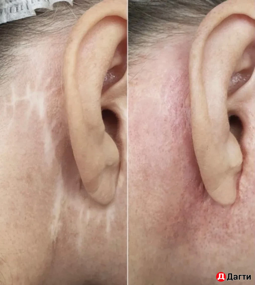 Перманентный камуфляж шрамов/рубцов, растяжек