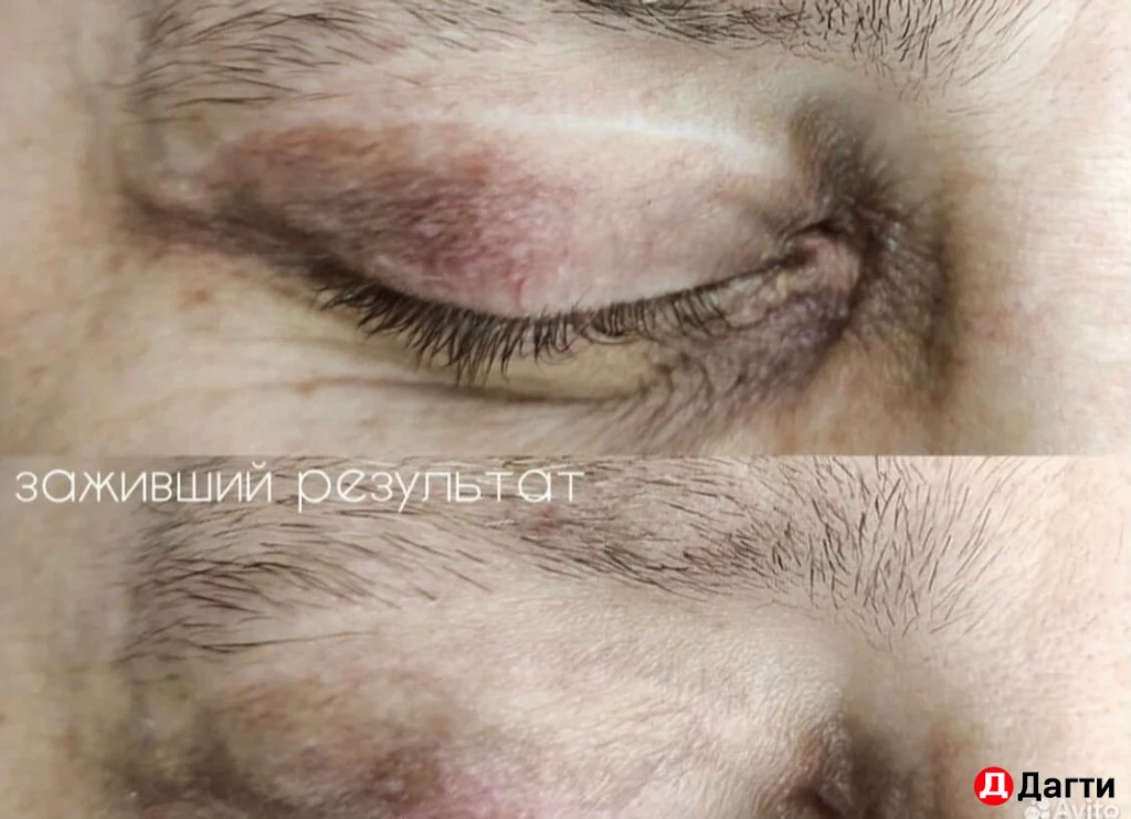 Перманентный камуфляж шрамов/рубцов, растяжек