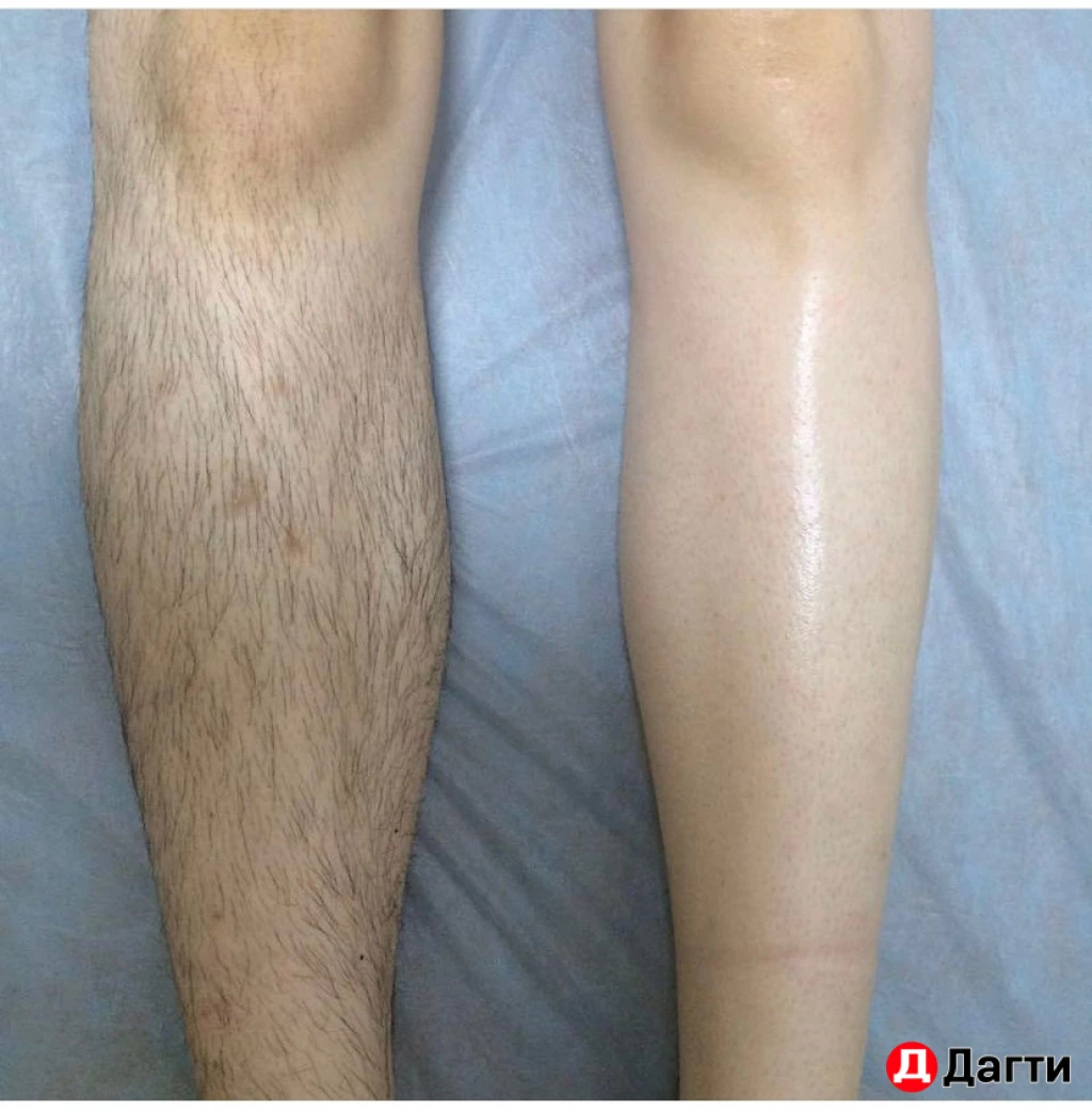 Депиляция воском